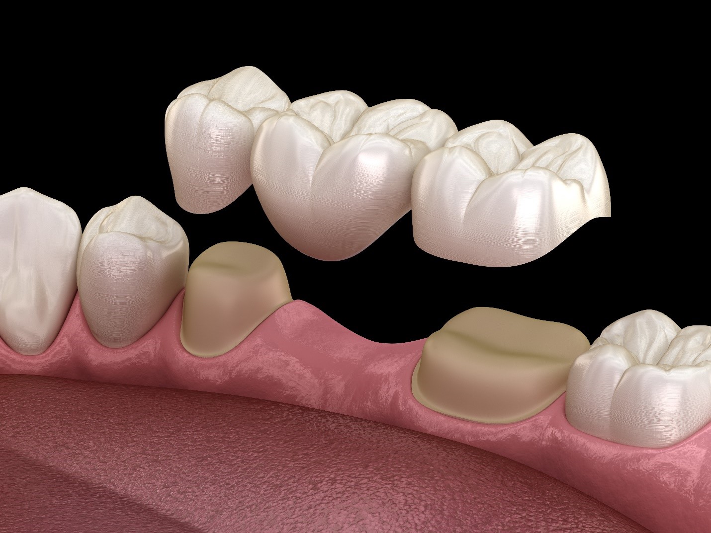 dental-bridge-illustration